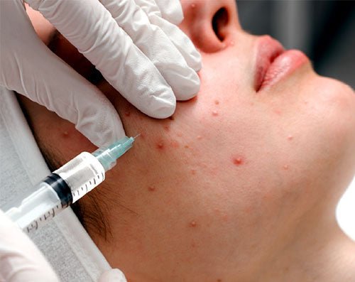 Understanding Acne and How to Manage It During Acne Awareness Month - Behold Aesthetics & Wellness Center
